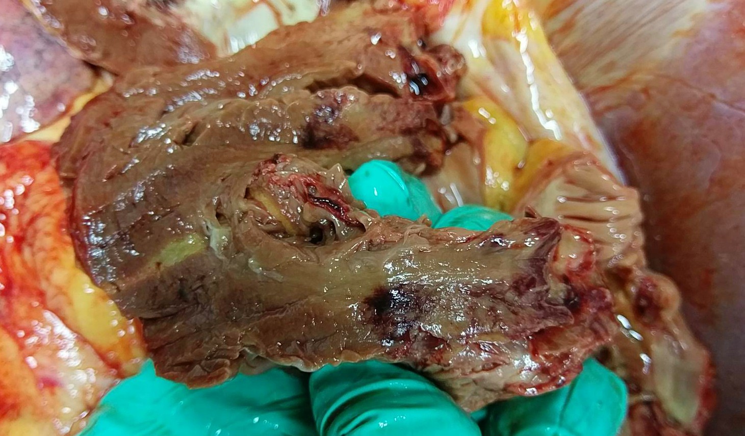 STEMI inf rv shark fin 2